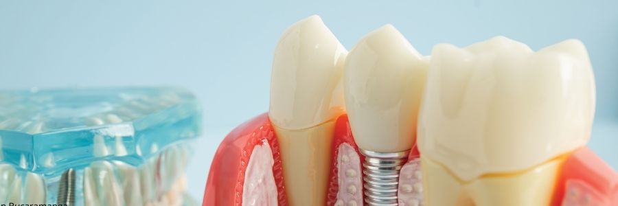 implantes dentales en san pedro sula honduras_